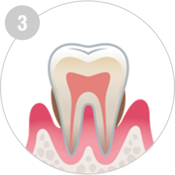 中度な歯周病